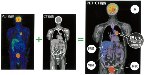 PET-CT画像